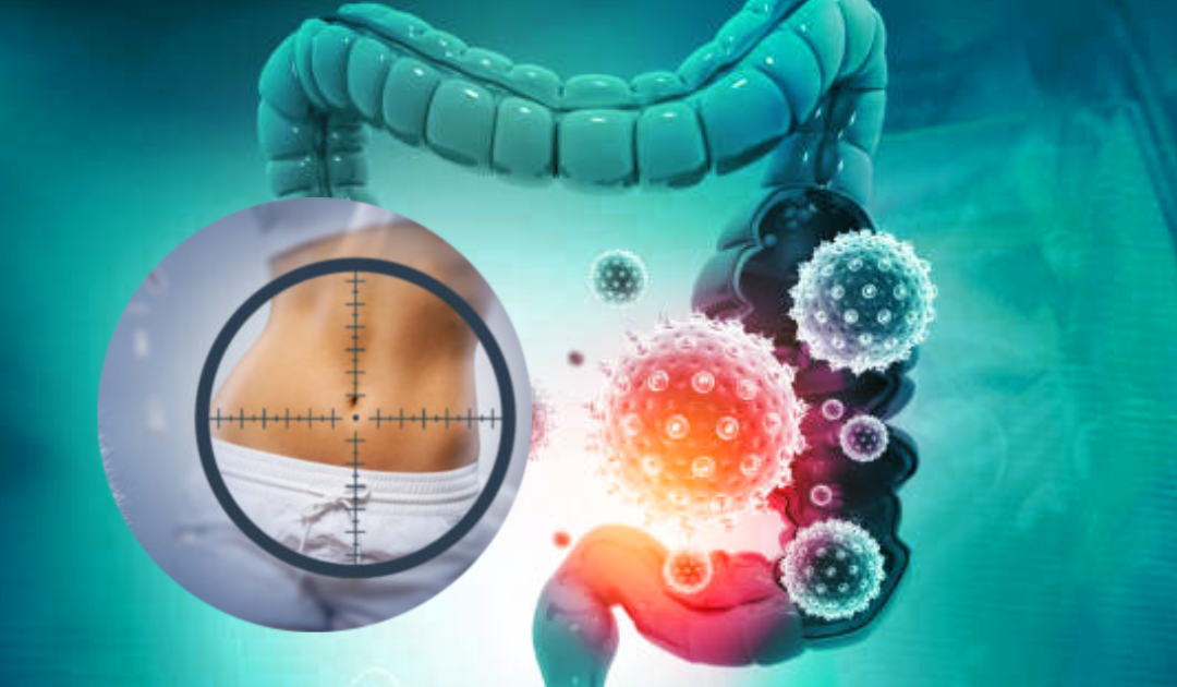 How I developed Intestinal Dysbiosis