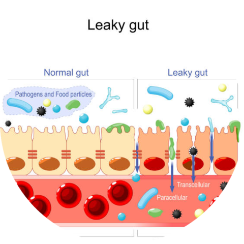 Leaky Gut Syndrome | 10 signs of leaky gut