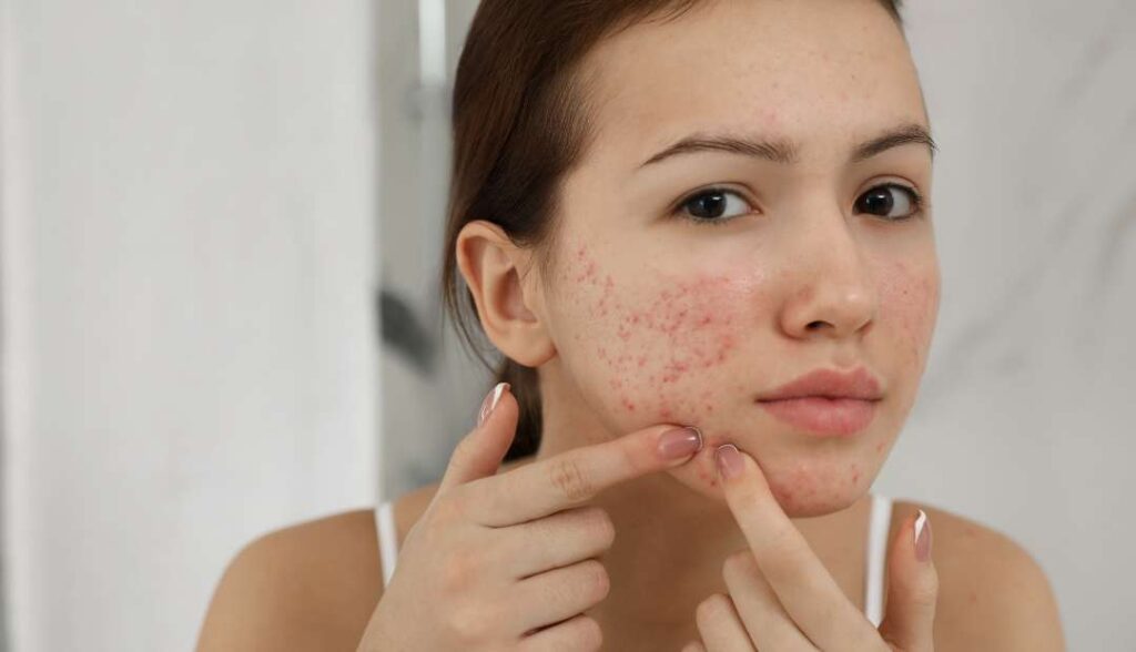 acne patch with microneedles